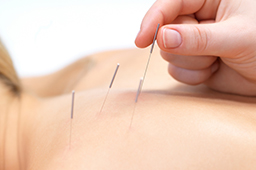acupuncture picture needles on back